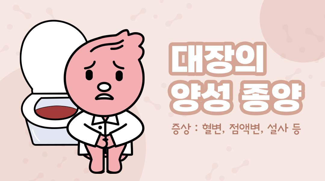 대장의 양성 종양이미지