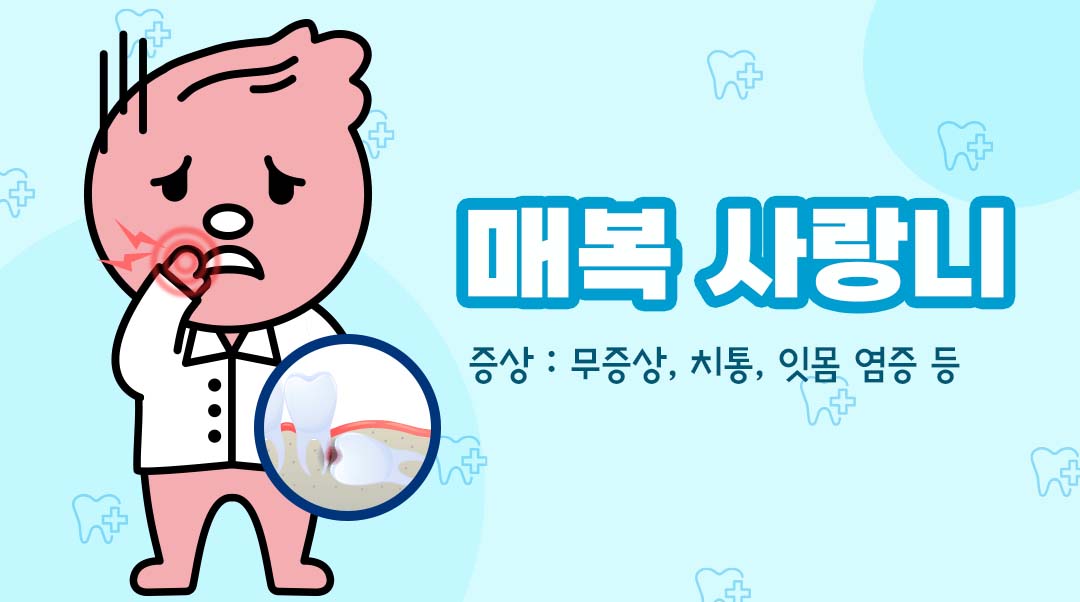 매복 사랑니이미지