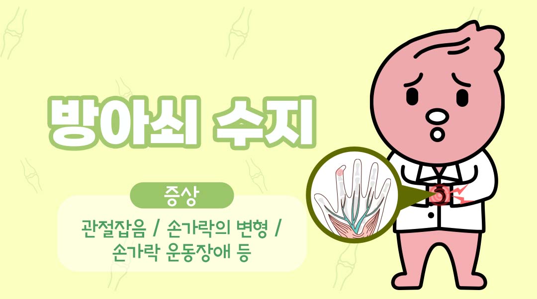 방아쇠 수지이미지