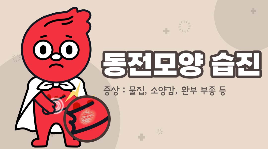 동전모양 습진이미지