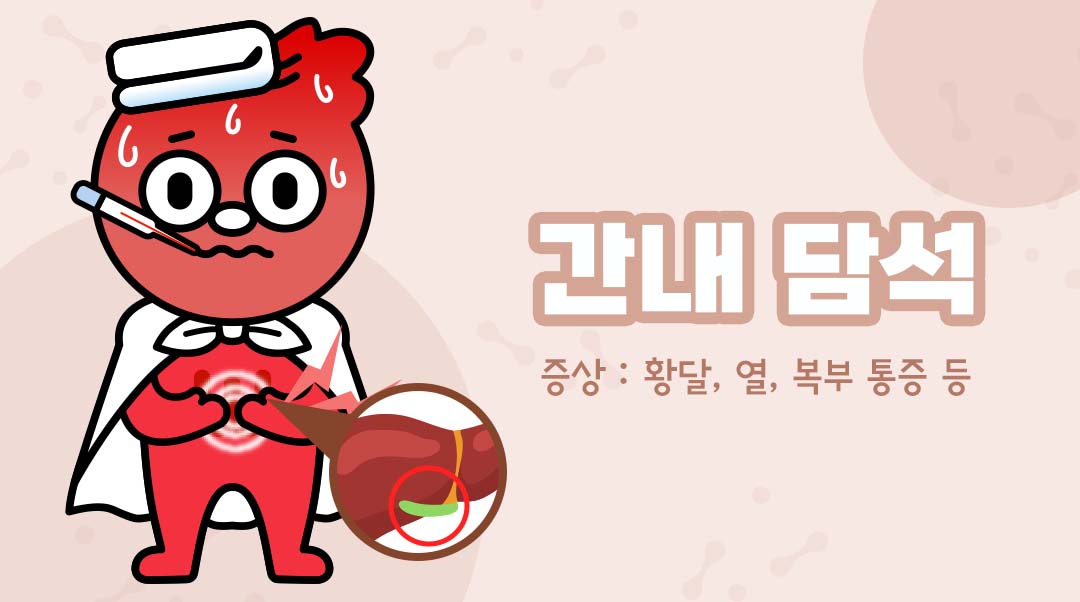 간내 담석이미지