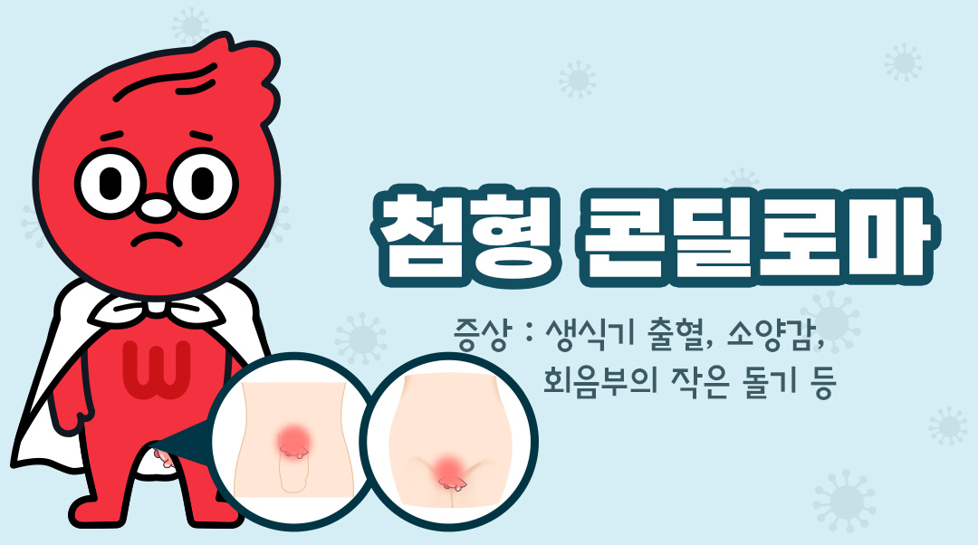 첨형 콘딜로마이미지