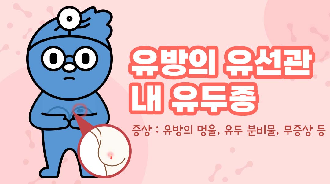 유방의 유선관 내 유두종이미지