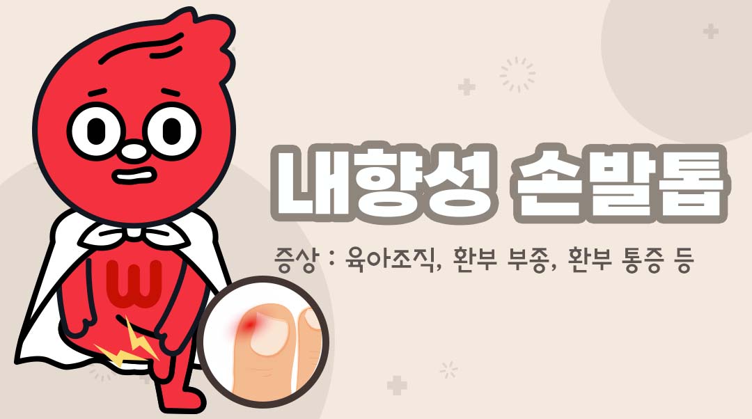 내향성 손발톱이미지