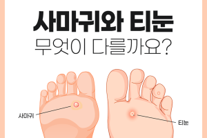 사마귀와 티눈, 무엇이 다를까요? - 카드뉴스 브이로그 4부  썸네일 이미지